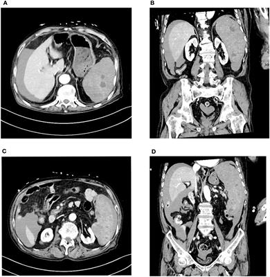 Spontaneous splenic rupture as the initial symptom of splenic angiosarcoma: case report and literature review